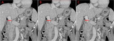 Case report: Characterization and bioinformatics analysis of non-O1/O139 Vibrio cholerae strain isolated from a choledochoduodenal fistula patient with septicemia